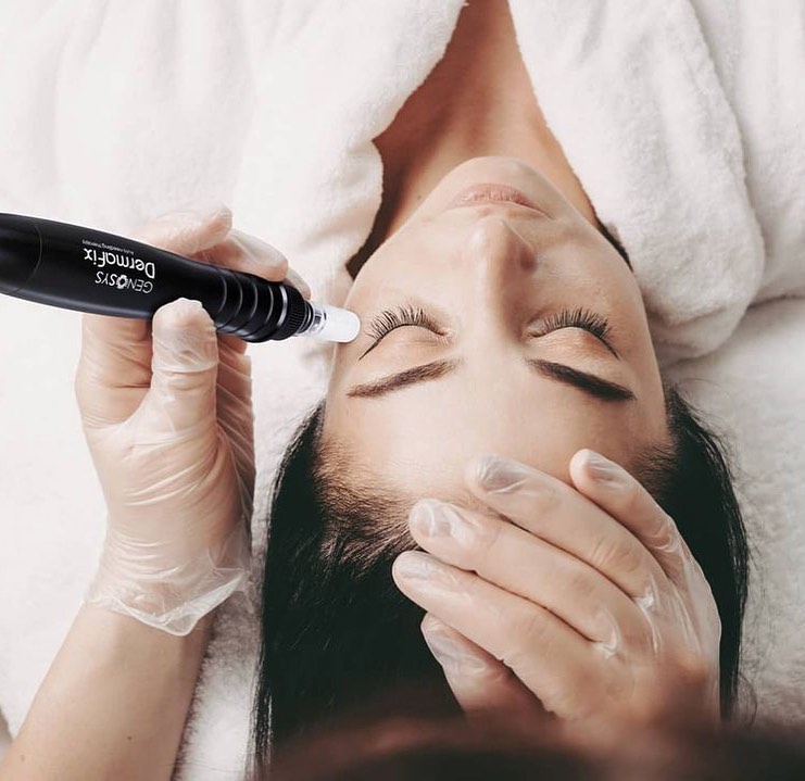 Microneedling Treatments in Bihops Stortford, A longterm rejuvenation programme that promotes new collagen and elastin.